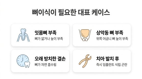 뼈이식이 필요한 대표 케이스 도식-AI 도식은 이해를 돕기 위한 개략도이며, 실제 치아 상태·치료 과정과 차이가 있을 수 있습니다