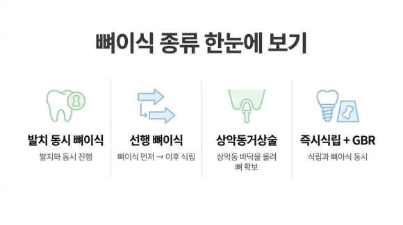 뼈이식 종류 도식 - AI 도식은 이해를 돕기 위한 개략도이며, 실제 치아 상태·치료 과정과 차이가 있을 수 있습니다.