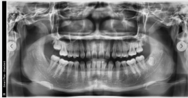 부정교합 치료 전후 파노라마 X-ray 실제 촬영 이미지