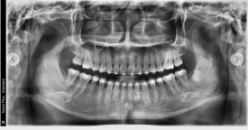 부정교합 치료 전후 파노라마 X-ray 실제 촬영 이미지