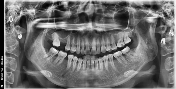 파노라마 X-Ray — 전체 치아 배열·악관절 확인