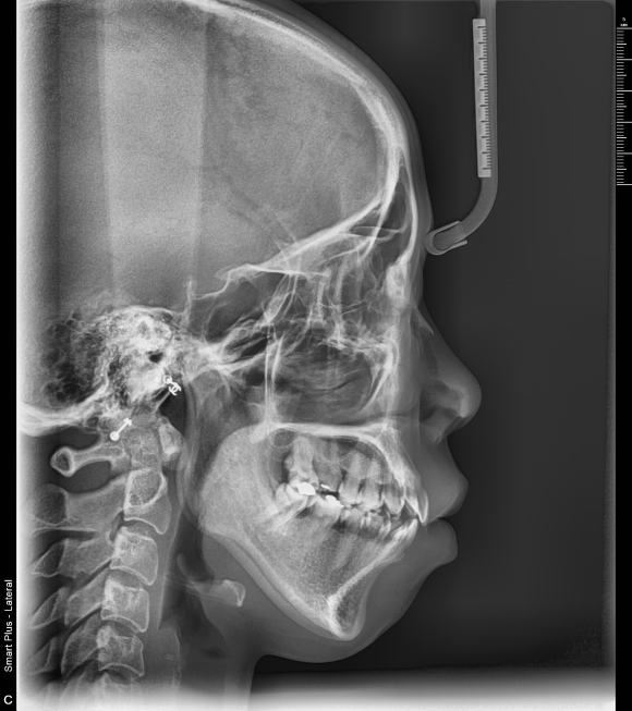 측면 세팔로 X-Ray — 골격·치아 전후 관계 분석