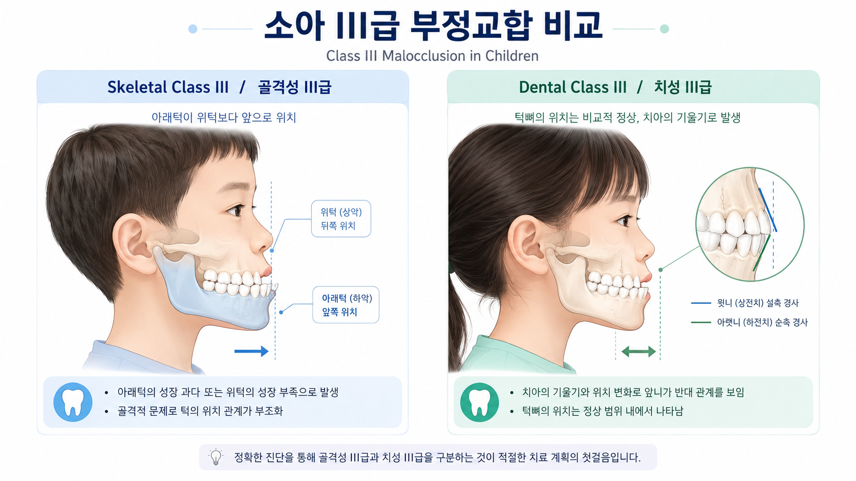 골격성 vs 치성 주걱턱 비교 인포그래픽