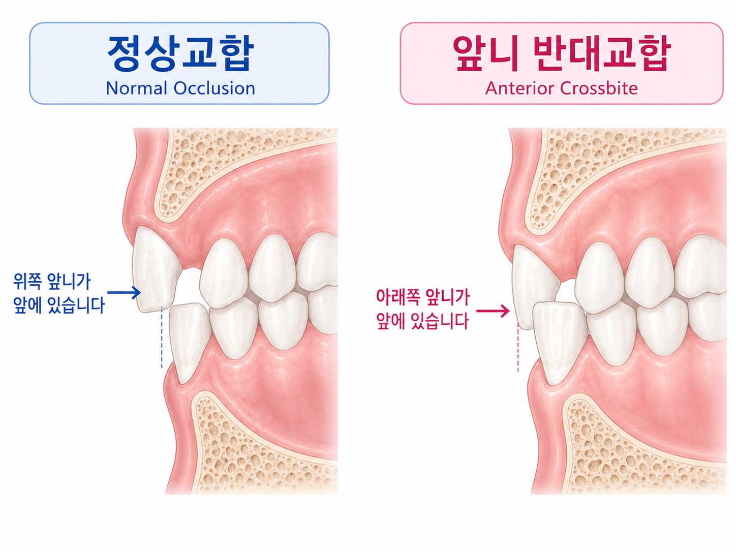 정상교합 vs 반대교합 비교