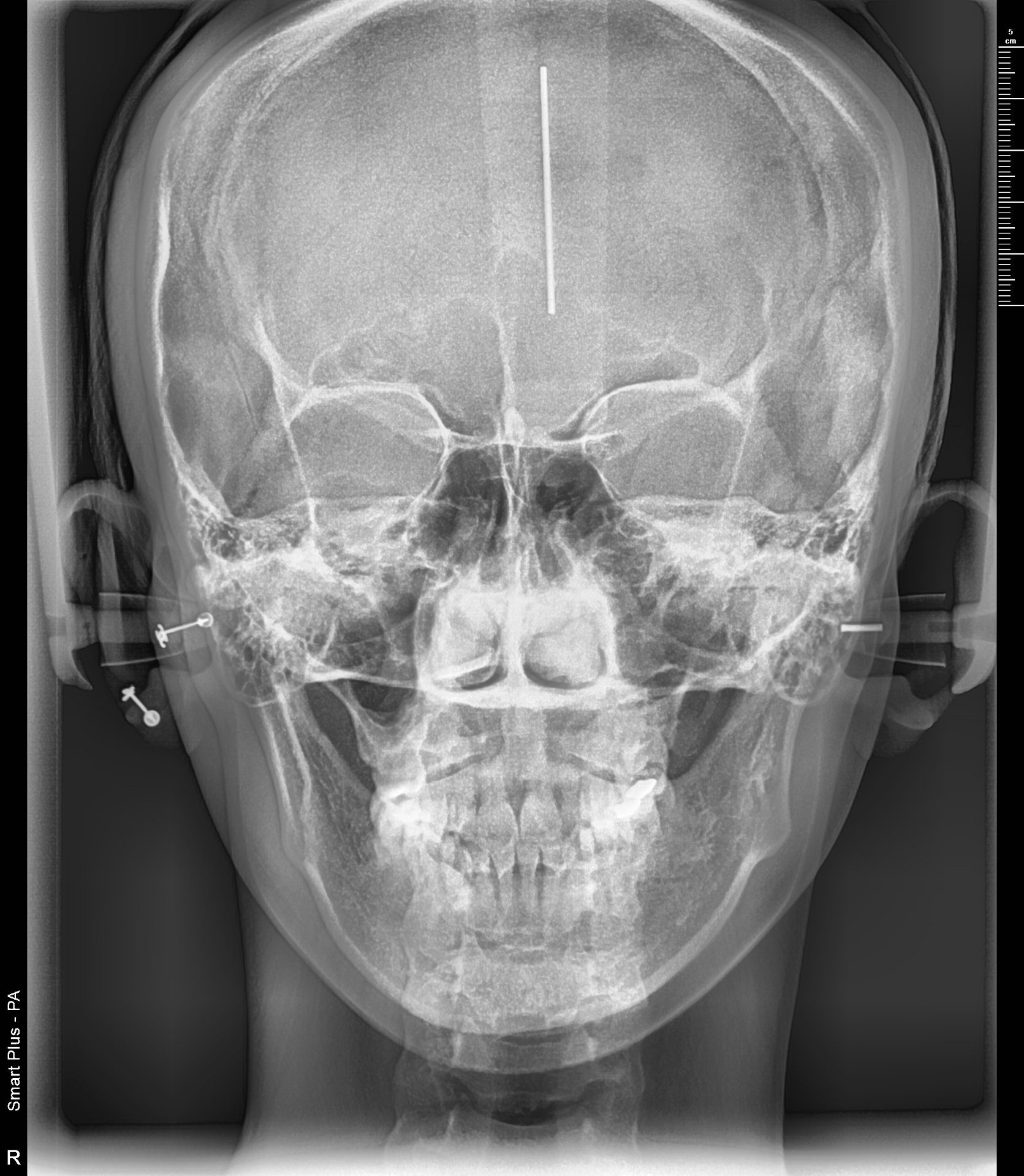 정면 세팔로 X-Ray — 좌우 대칭·안면비대칭 평가