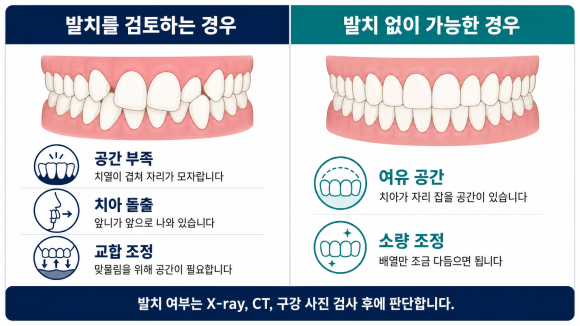 발치 여부 판단 기준 비교